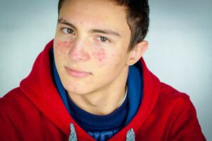 Mara-laser-treatments-for-acne-boy