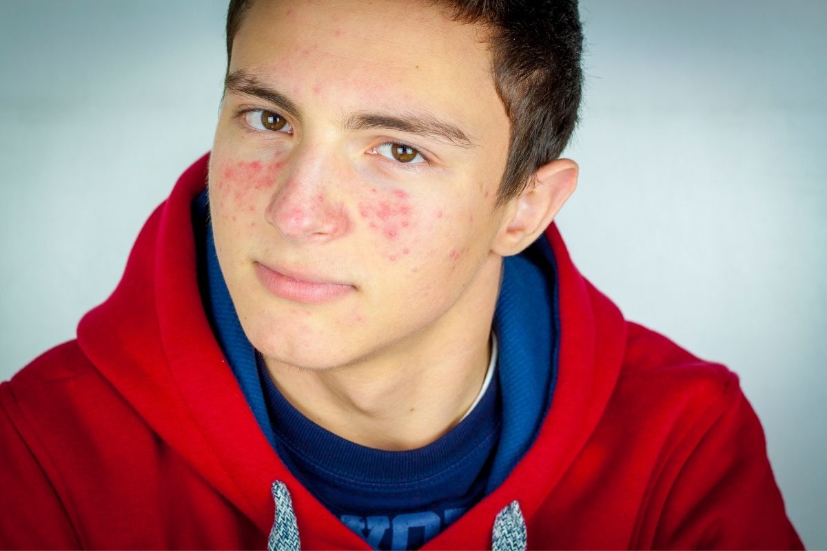 Mara-laser-treatments-for-acne-boy