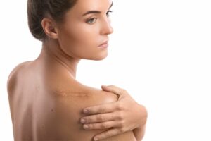 Mara - treatment for scars in Austin