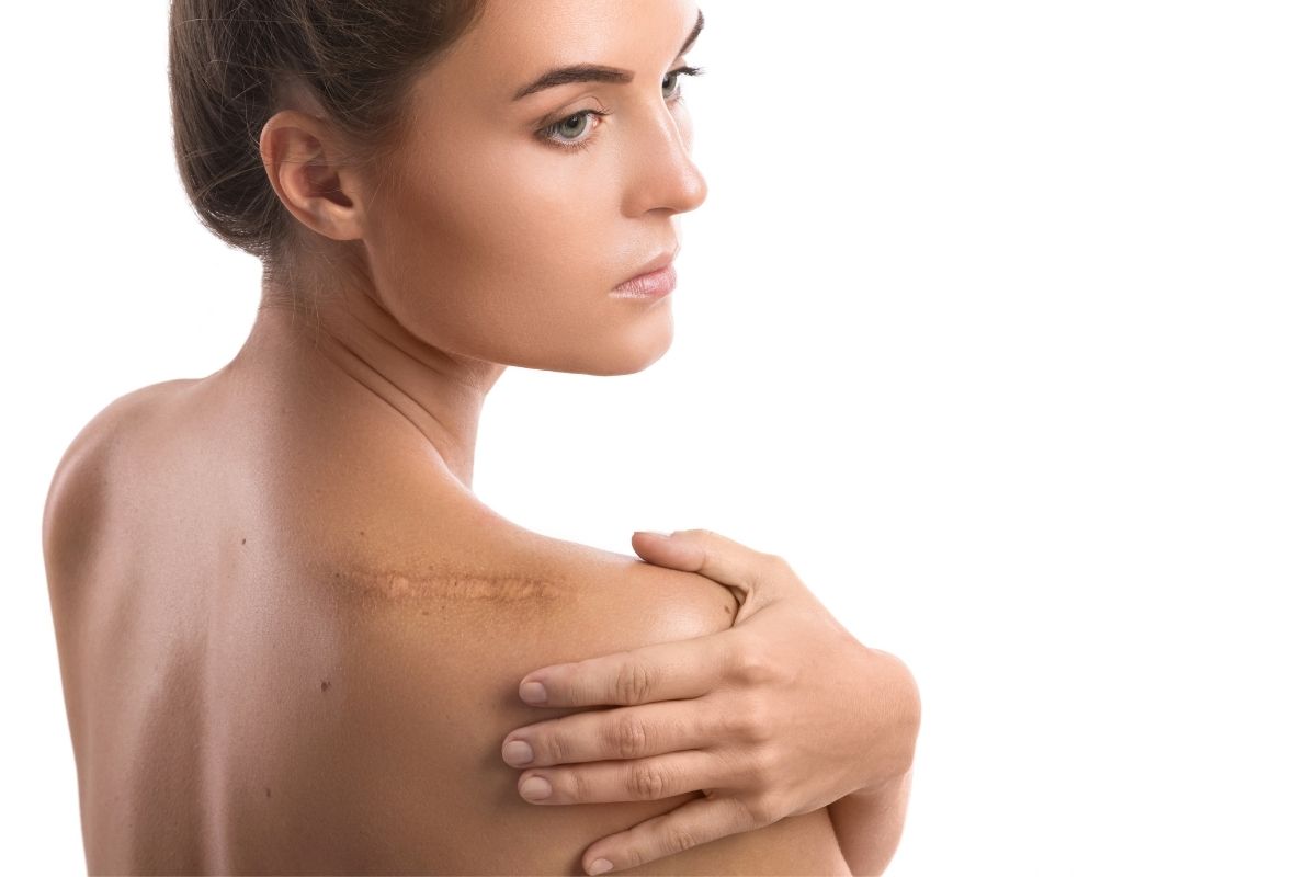 Mara - treatment for scars in Austin