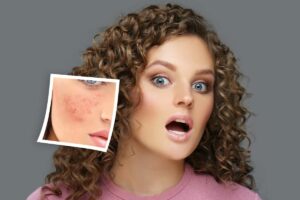 Mara - laser treatments for rosacea before and after