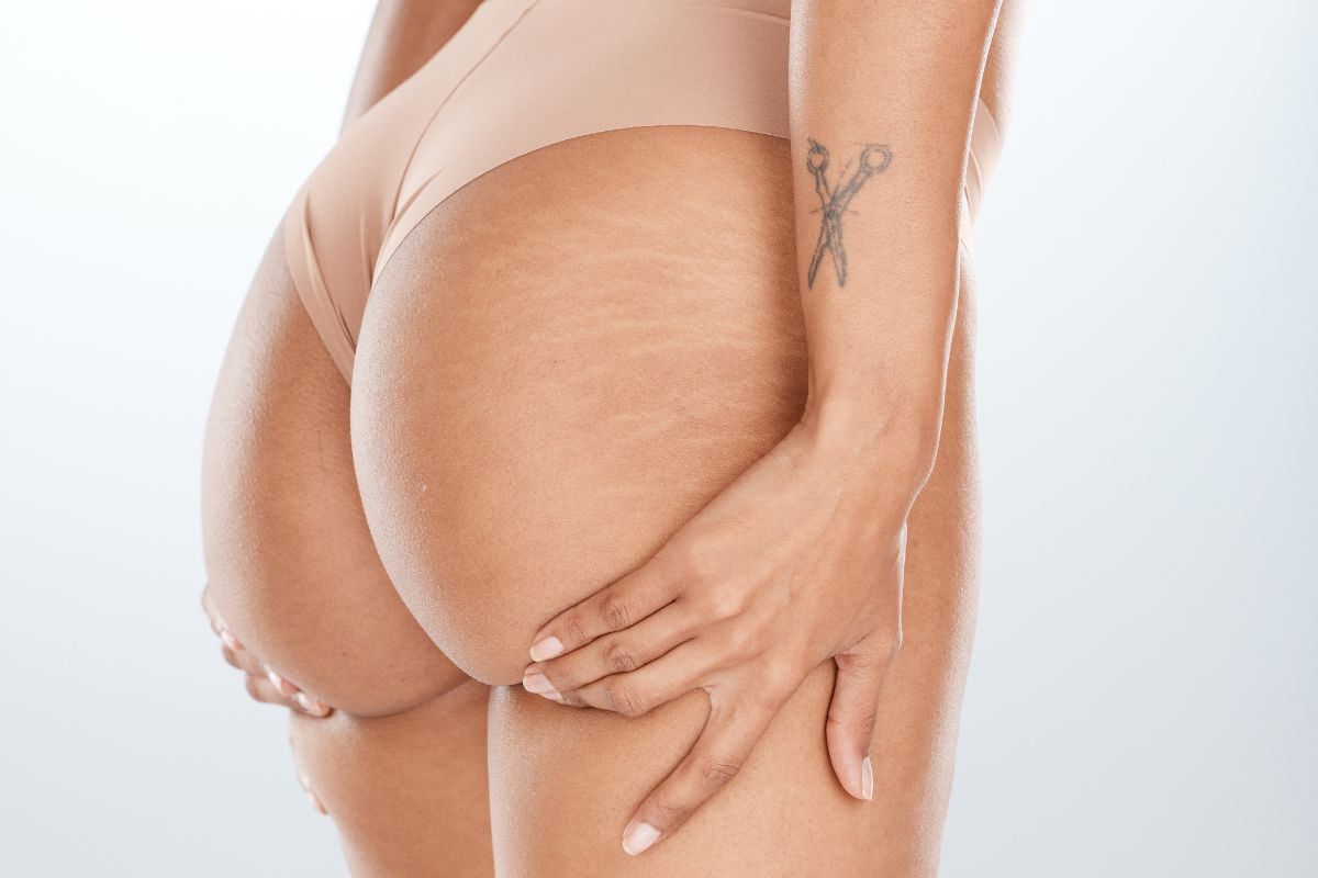 Mara-microdermabrasion-for-stretch-marks-1