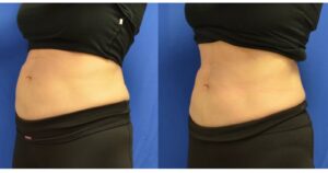 CoolTone Muscle Toning Treatment