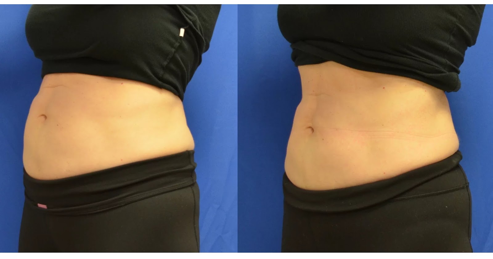 CoolTone Muscle Toning Treatment