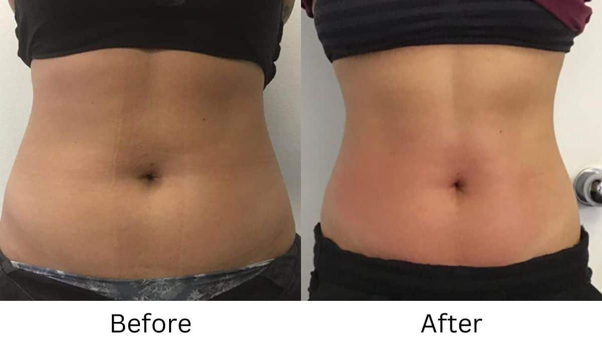 Venus Bliss MAX™ Treatment