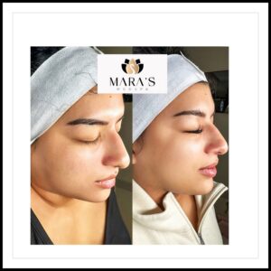 Dermal Fillers in Austin