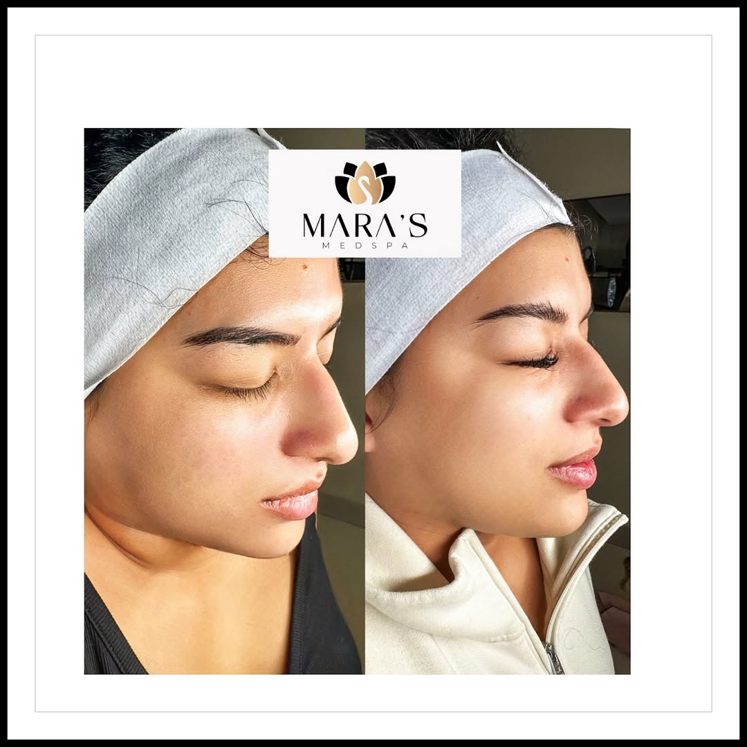 Dermal Fillers in Austin