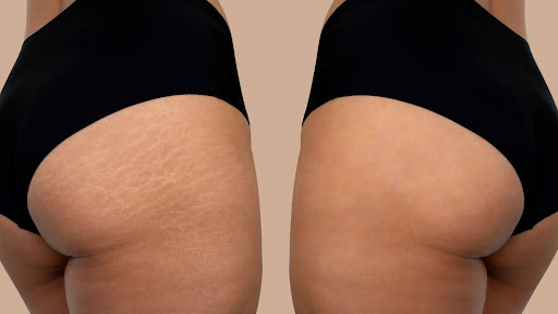 Laser Stretch Mark Removal Austin, TX