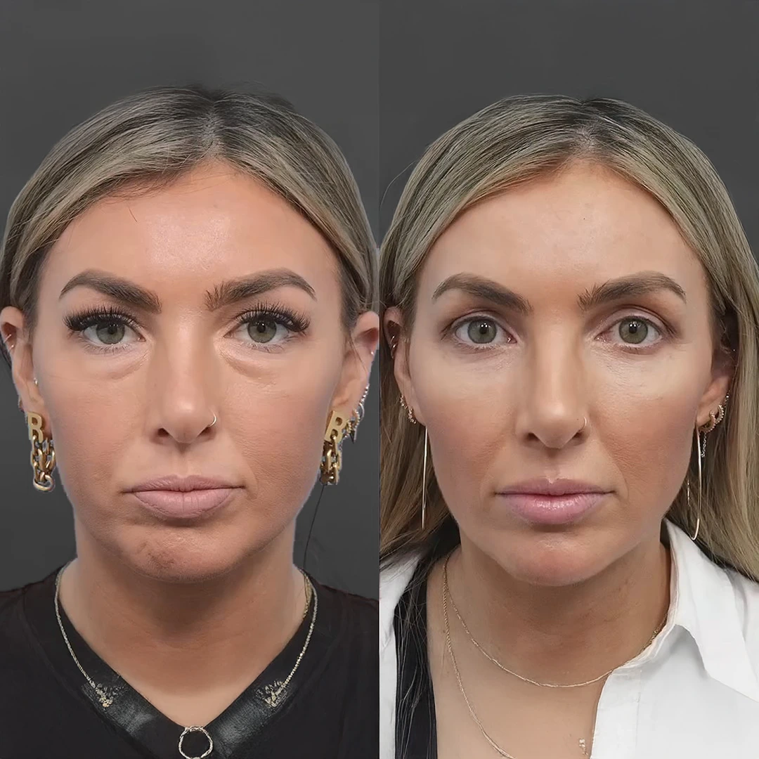 BrightEye results — smoother fine lines and less puffiness in the under-eye area