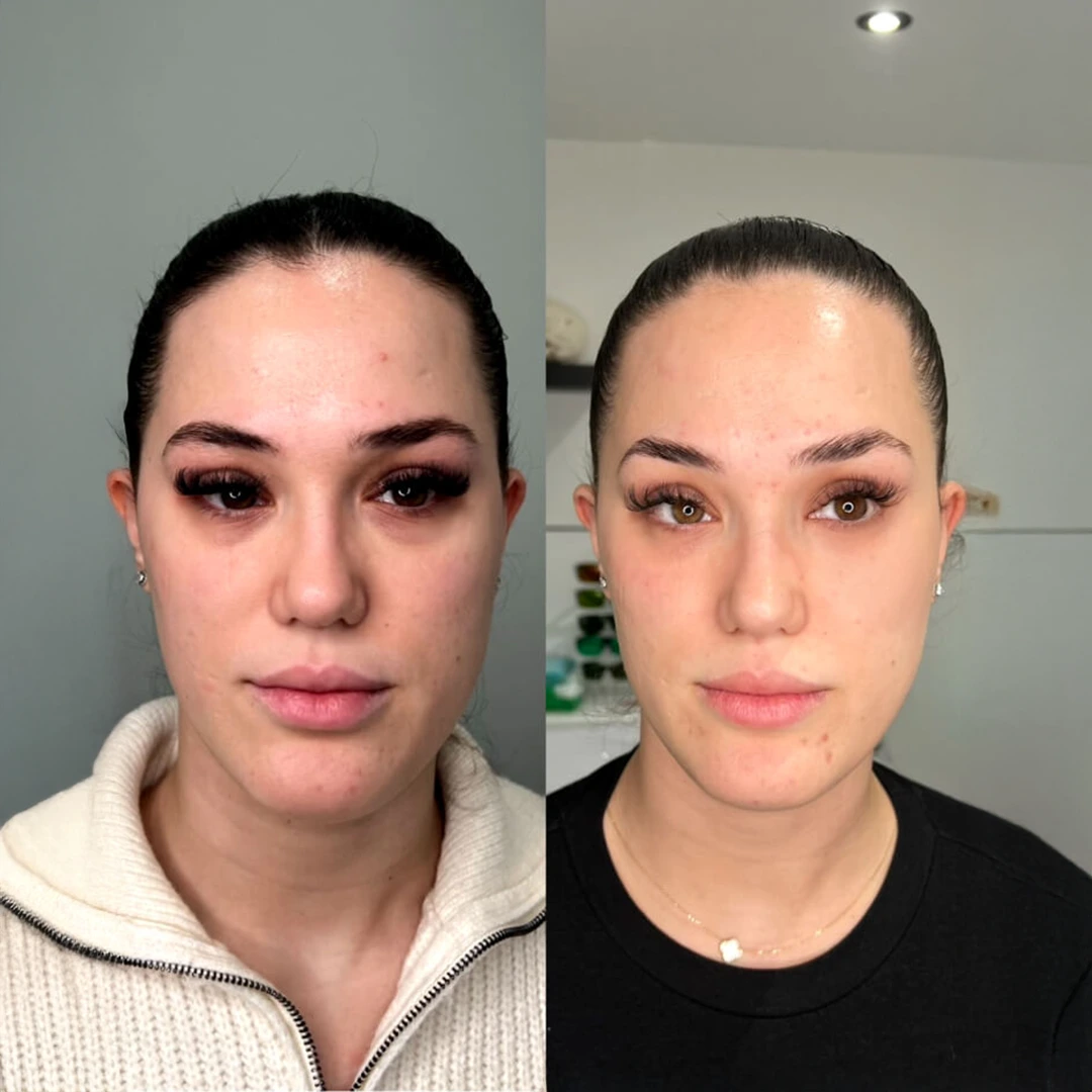 BrightEye under-eye injectable in Austin — before and after showing brighter tone and reduced dark circles