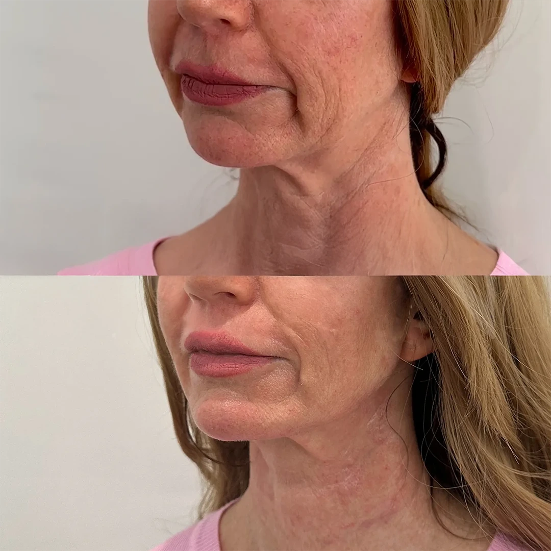 thread lift in dallas — before and after using PDO mono threads to lift the midface and jawline for a refined Non-Surgical Facelift effect