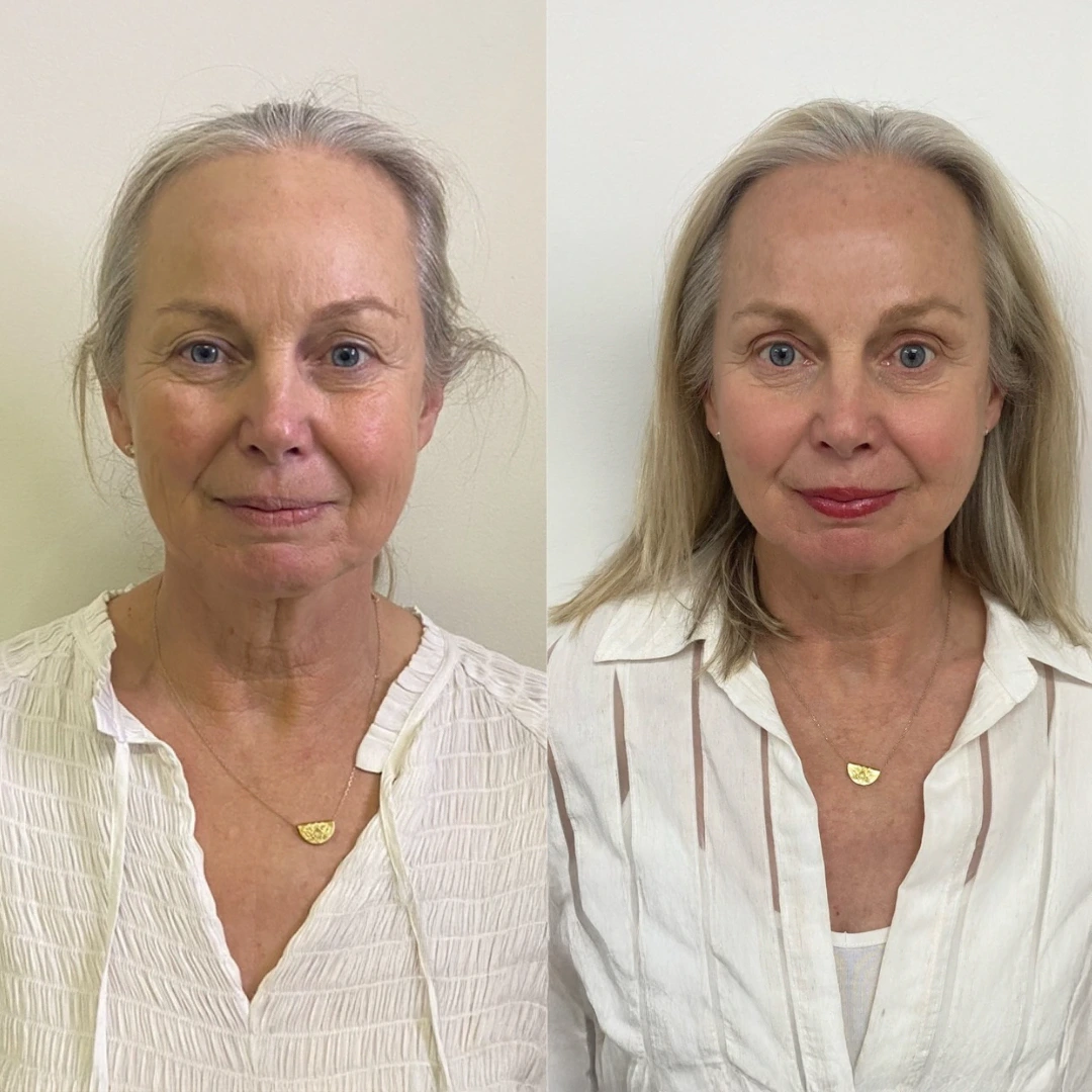 mono thread lift in dallas — before and after smoothing and lifting along the lower face with PDO threads for a subtle Non-Surgical Facelift result