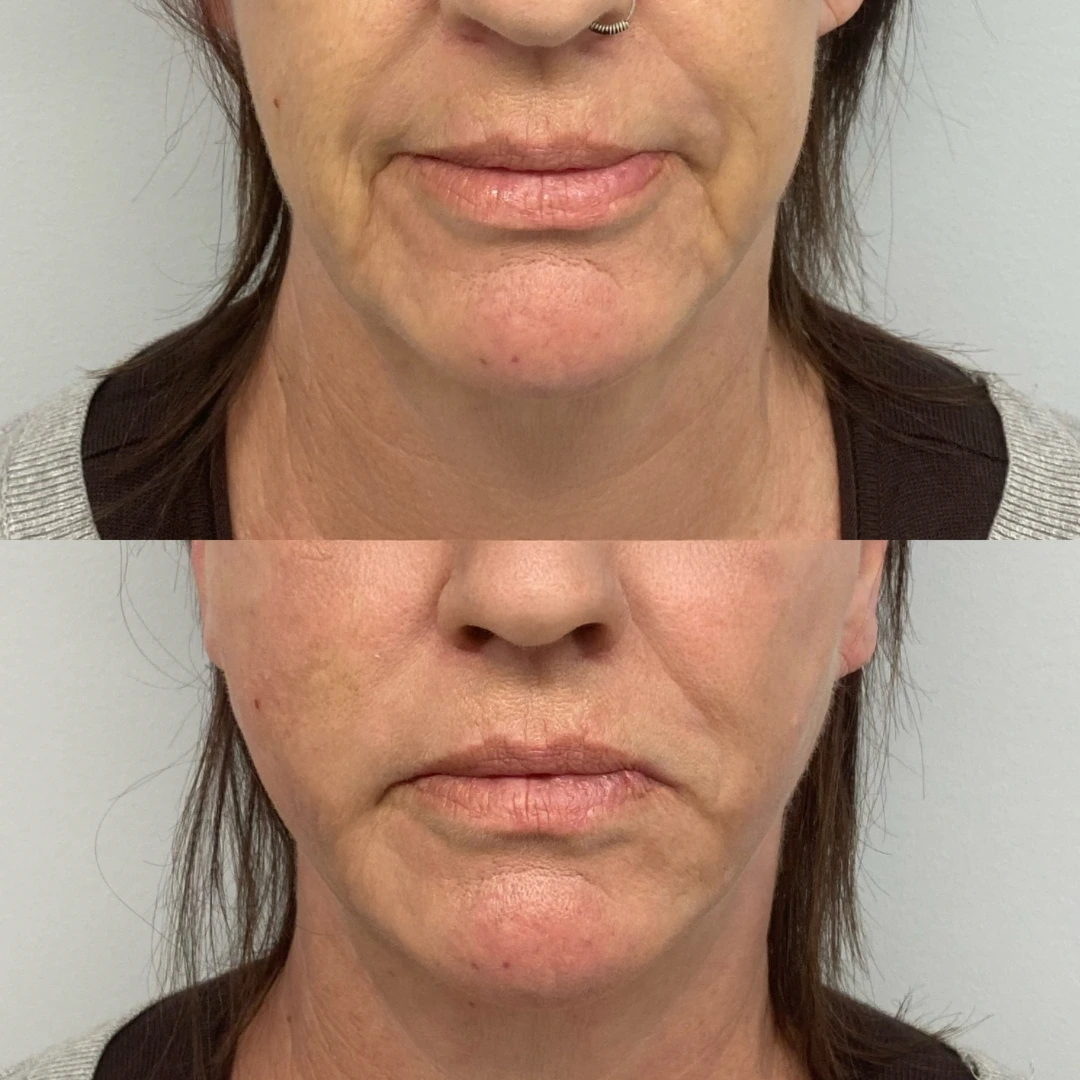 pdo threads lift in dallas — before and after showing cheek and nasolabial support with PDO mono threads for a Non-Surgical Facelift look