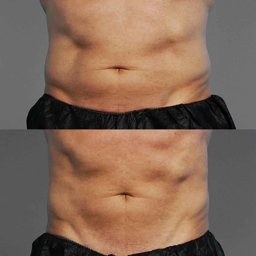 Minted's Med Spa — body sculpting in Austin highlighting increased core definition