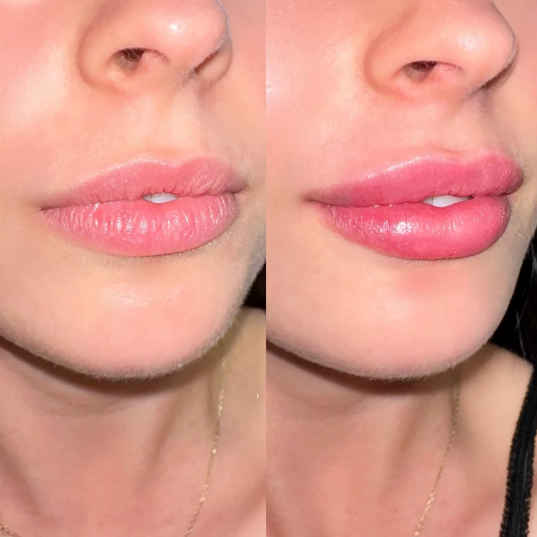 Dysport in Uptown Austin — refined forehead lines with natural movement