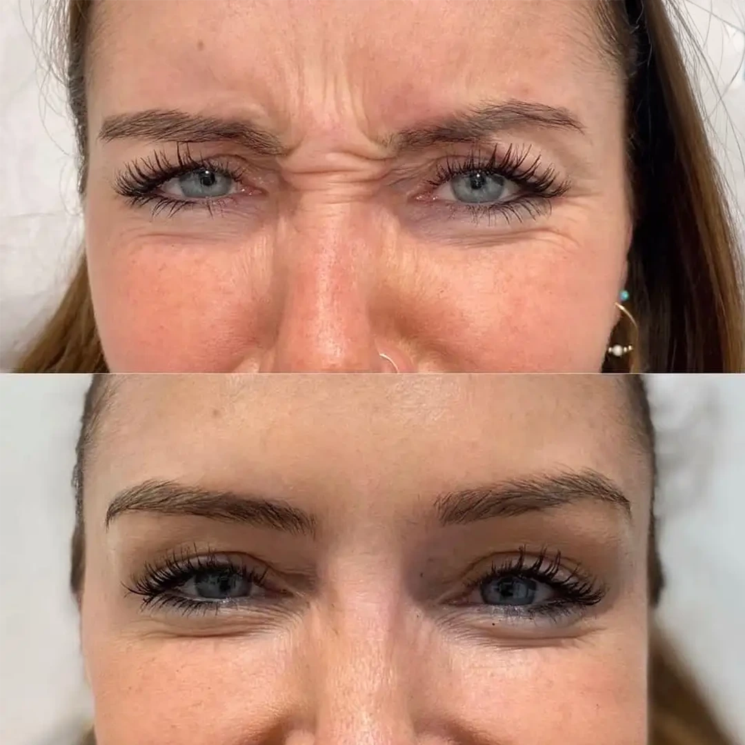 Dysport in Austin — before and after showing softer frown lines and a smoother brow