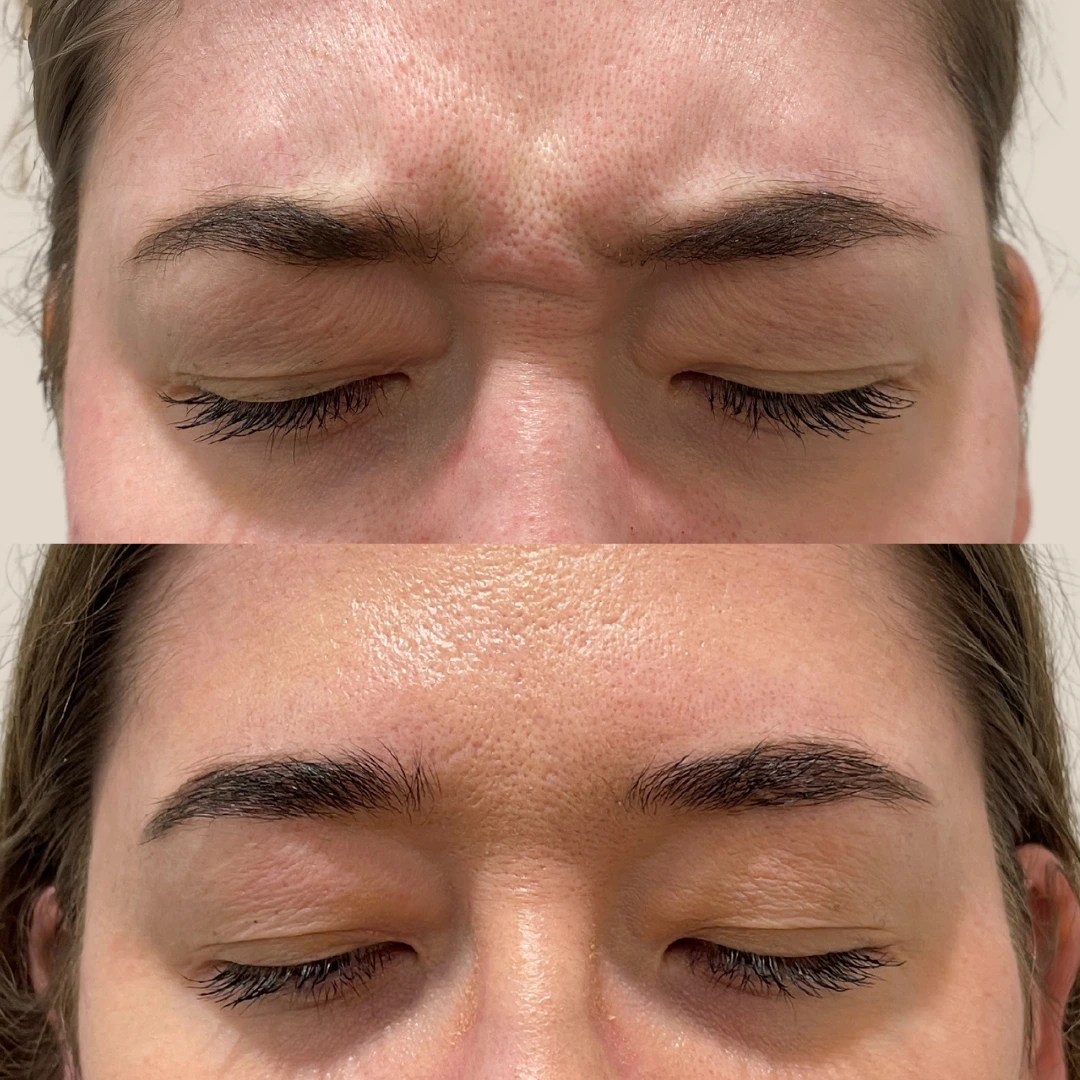 Dysport for Lips in Austin — lip flip in Austin for a subtly fuller upper lip