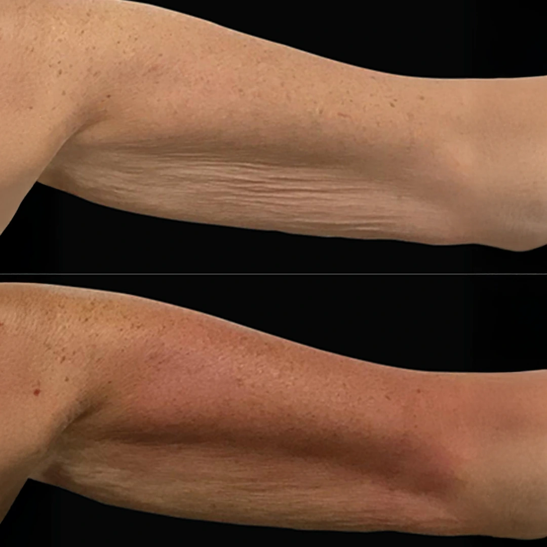 HeatWave before and after — underarms (upper arms) with refined contour and lift