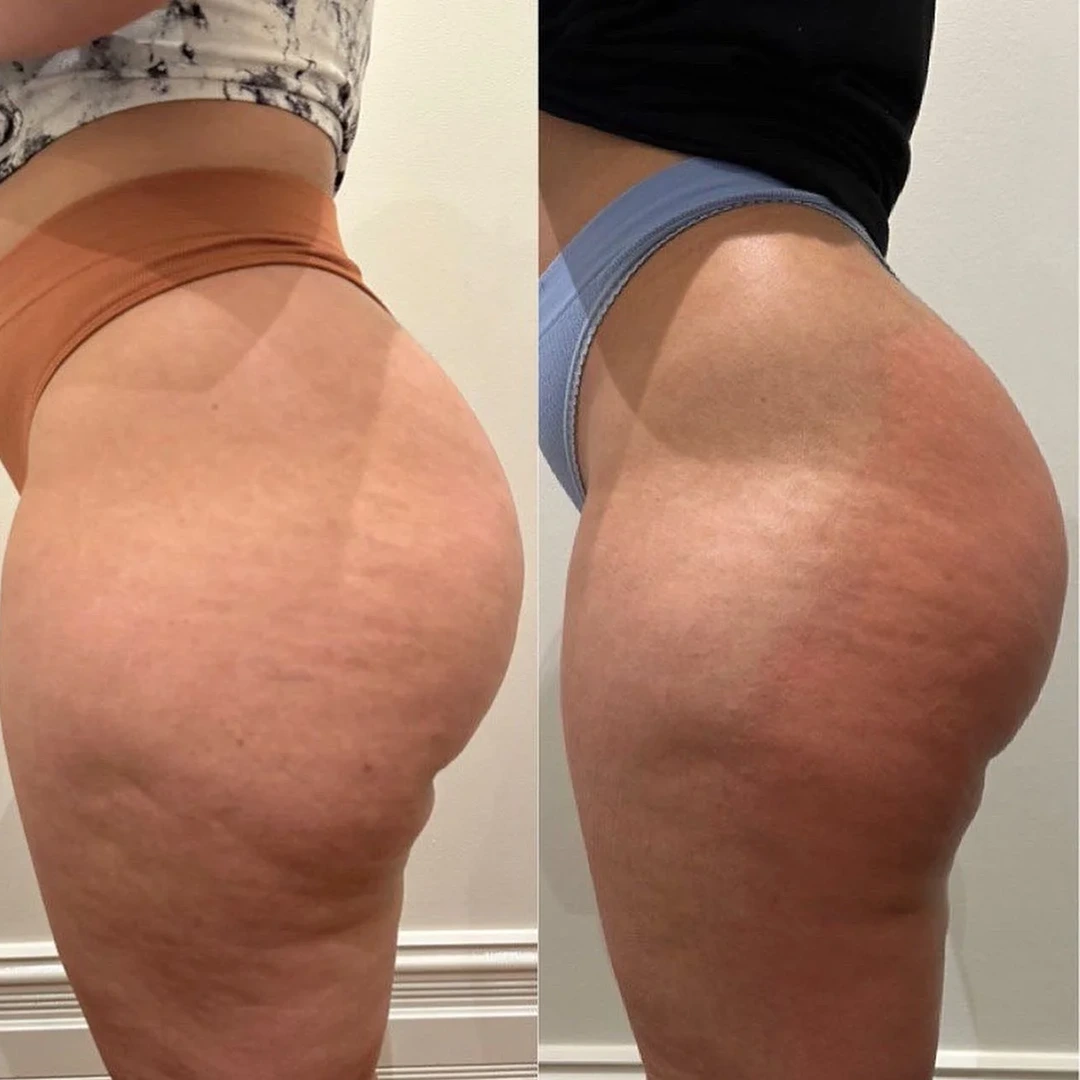 HeatWave before and after — back of thighs smoothing and firmer contour