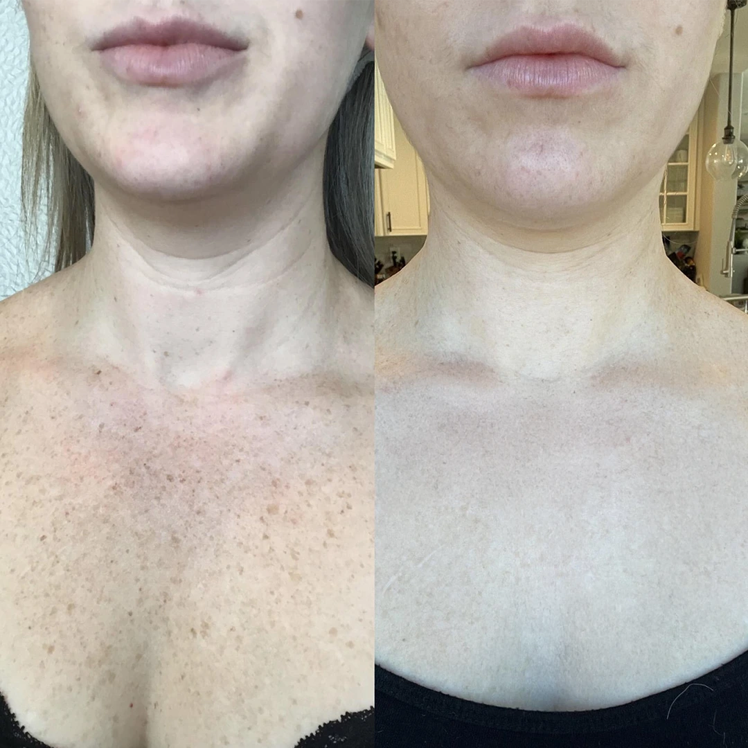 IPL Photofacial in Austin (photofacial dallas) — décolleté before and after with reduced sun spots and improved brightness