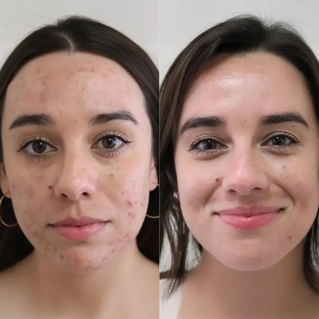 Acne Treatment in Austin — before and after reduction in active breakouts and redness with AC Dual IPL photothermal therapy