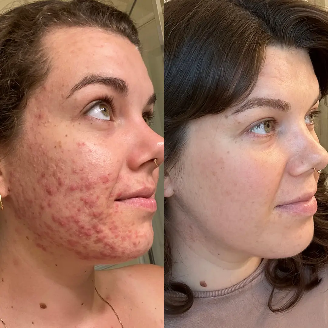 Laser skin resurfacing in Austin — before and after showing smoother texture and more even tone with AC Dual / IPL