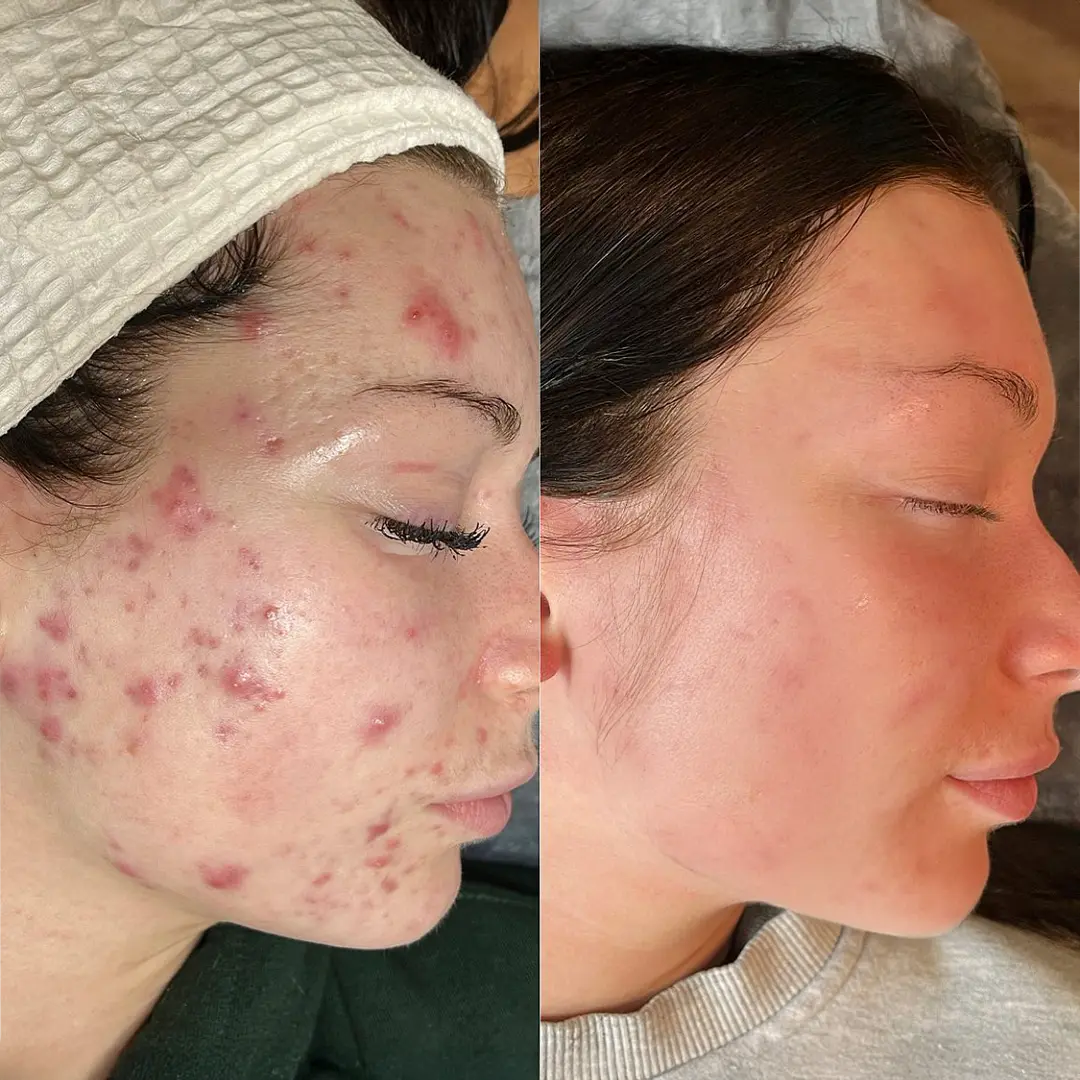 Venus Versa in Austin — before and after with clearer tone and refined pores using AC Dual dual-filter IPL
