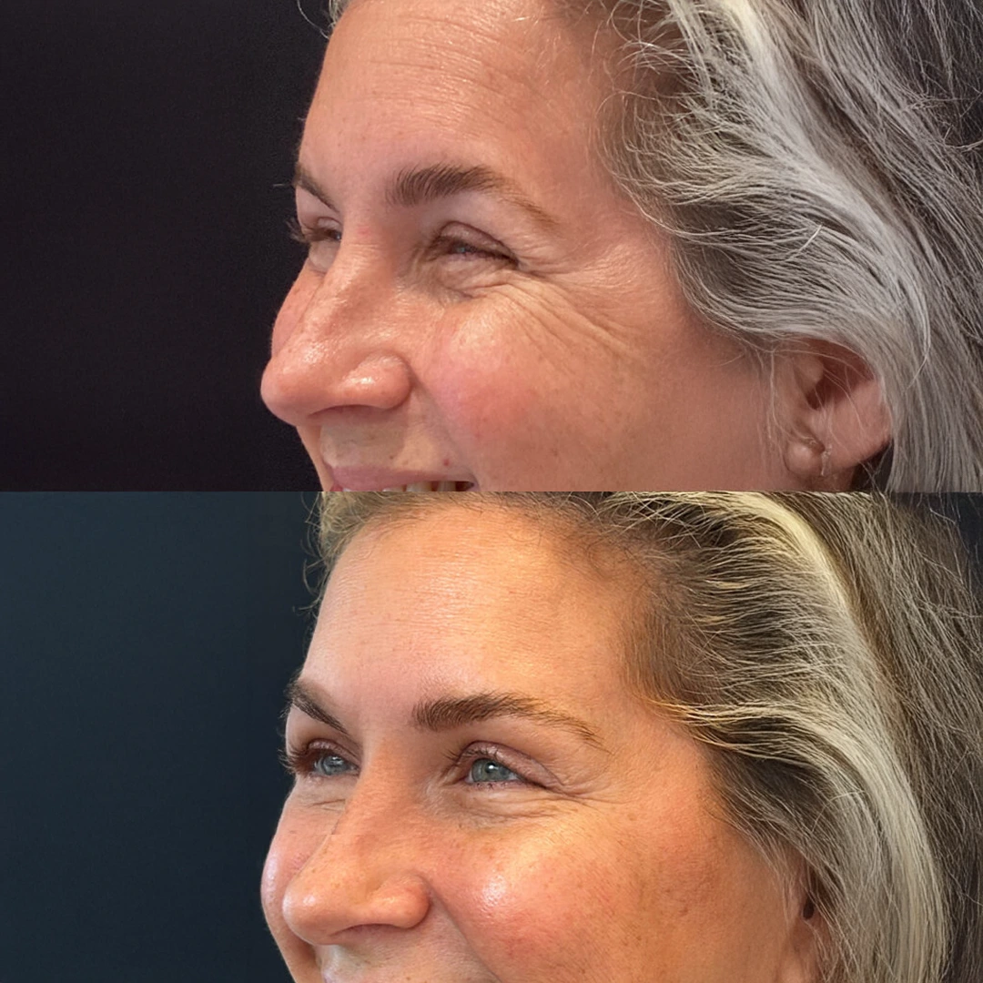 Letybo for Wrinkles in Austin — before and after smoothing frown lines and crow’s feet (female)