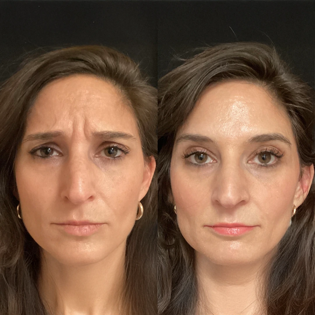 Letybo Wrinkle Relaxer Austin — before and after refining forehead lines with natural movement (female)