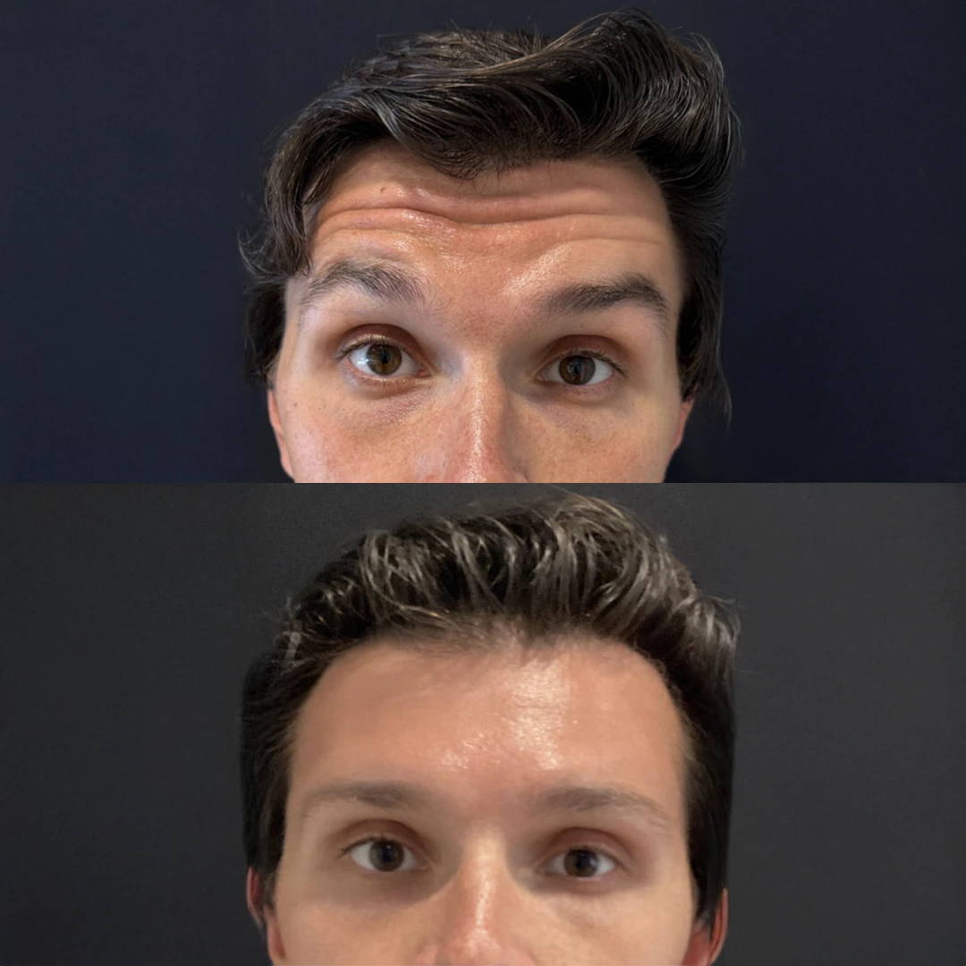 Botox Alternatives in Austin — Letybo before and after softening forehead and frown lines (male)