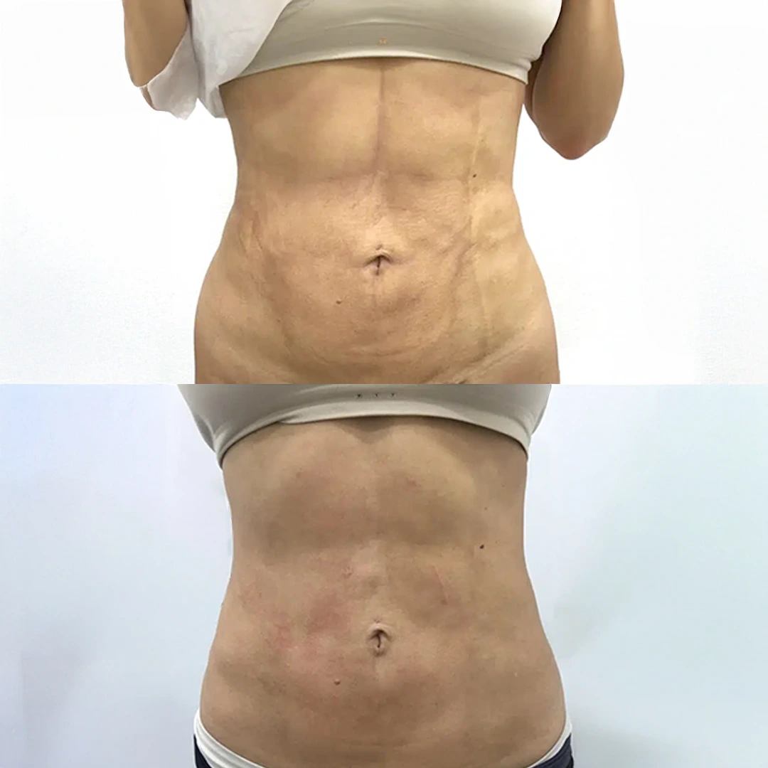 Venus Legacy in Austin — abdomen before and after showing tighter, smoother skin and improved contour