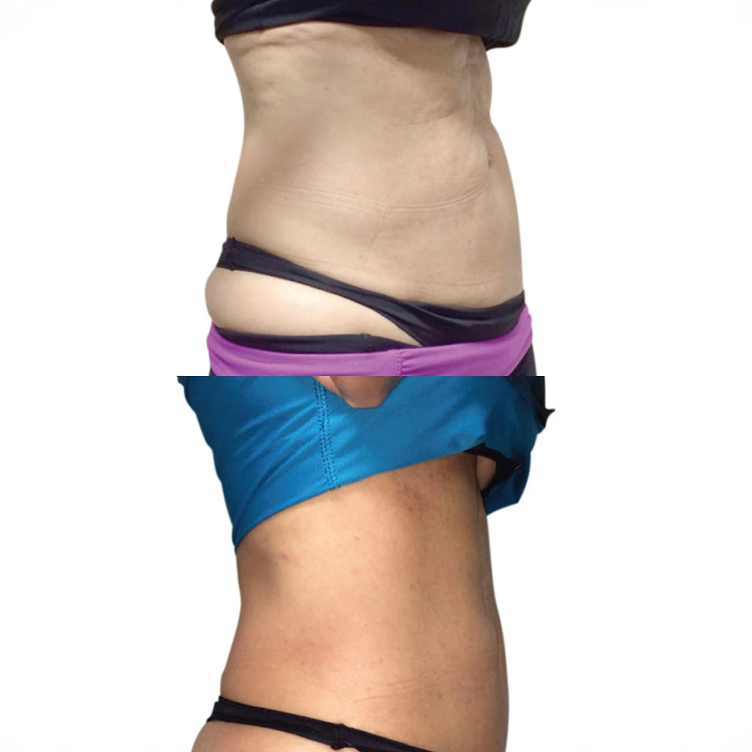 RF Skin Tightening in Austin — abdomen before and after using Venus Legacy with firmer, more refined tone