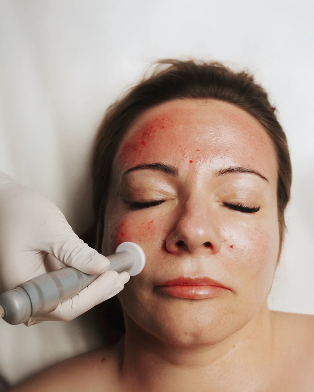 Austin Red-Carpet Facial before and after in Austin